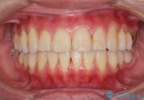 捻れた奥歯 突き出た前歯を治したいの治療後