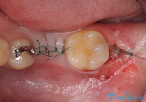 虫歯の再発による抜歯後のインプラント治療の治療中