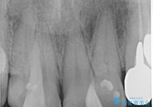 前歯が気になる。ブリッジによる治療。の治療前