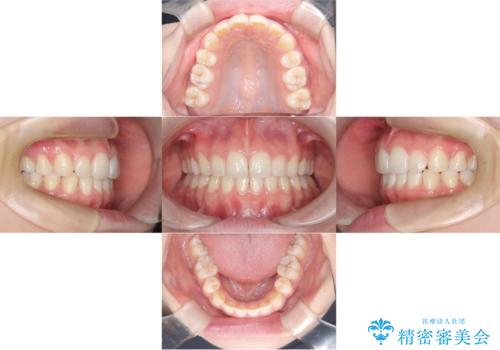 【ワイヤー矯正!】歯のでこぼこと捻じれを治したい!の治療後