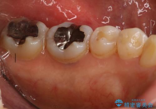 下の奥歯の銀歯を白くしたいの治療前