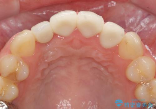 [ 審美歯科治療 ]  充填物でつぎはぎだらけの前歯をセラミックにの治療後
