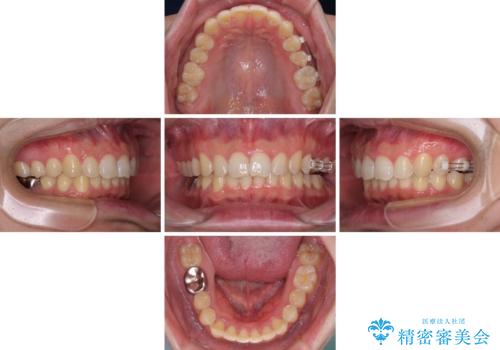 ねじれの強い前歯と奥歯　インビザラインでの矯正治療の治療中