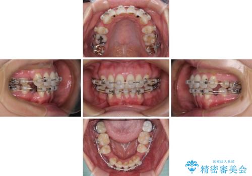 前方に飛び出した前歯　ワイヤー装置での抜歯矯正の治療中