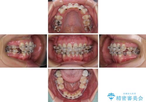 前方に飛び出した前歯 ワイヤー装置での抜歯矯正の治療中