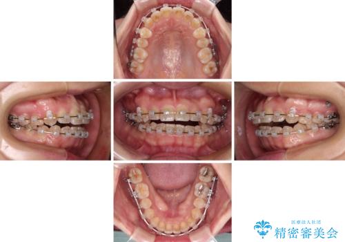 八重歯を治す　非抜歯のワイヤー矯正治療の治療中