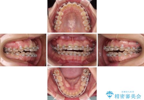 八重歯を治す 非抜歯のワイヤー矯正治療の治療中