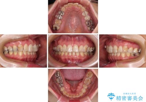 インビザラインが続けられない 忍耐のマウスピース矯正の治療中