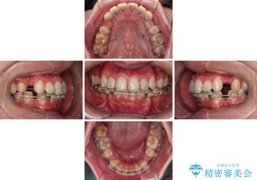 顎が左右にずれた咬み合わせ ハーフリンガルの抜歯矯正の治療中