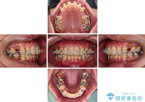 【モニター】口が閉じにくい　抜歯矯正でスッキリした口元にの治療中