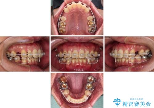 【モニター】口が閉じにくい 抜歯矯正でスッキリした口元にの治療中