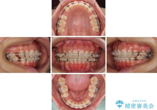 閉じにくい口元をワイヤー抜歯矯正でスッキリした口元にの治療中