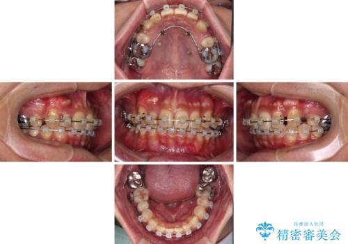 【モニター】八重歯と正中のずれた歯列　片顎抜歯のワイヤー矯正の治療中