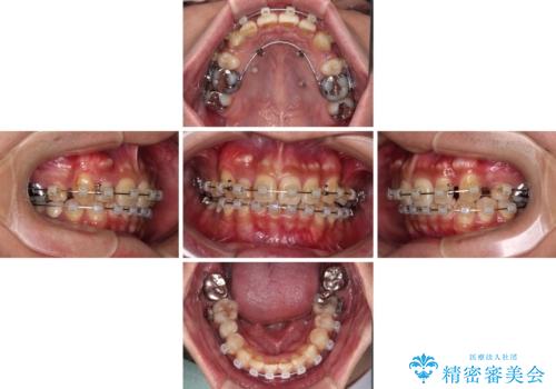 【モニター】八重歯と正中のずれた歯列 片顎抜歯のワイヤー矯正の治療中