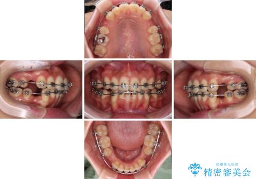 【モニター】飛び出した上顎前歯を抜歯矯正で引っ込める　ワイヤー装置の抜歯矯正治療の治療中