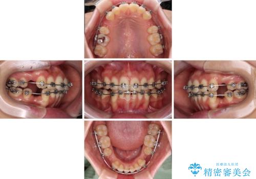 【モニター】飛び出した上顎前歯を抜歯矯正で引っ込める ワイヤー装置の抜歯矯正治療の治療中