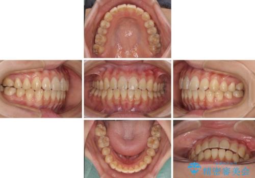 舌の突出癖による開咬と前歯の突出 インビザライン矯正治療の治療中