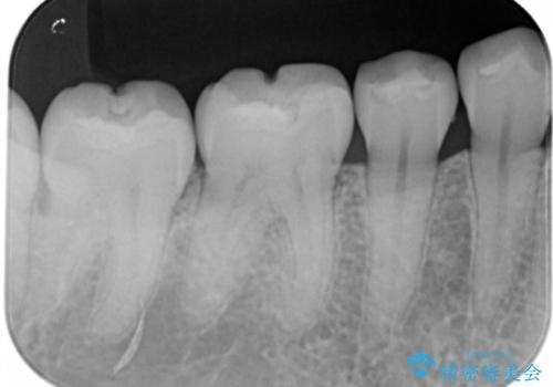 奥歯を綺麗にしたいの治療前