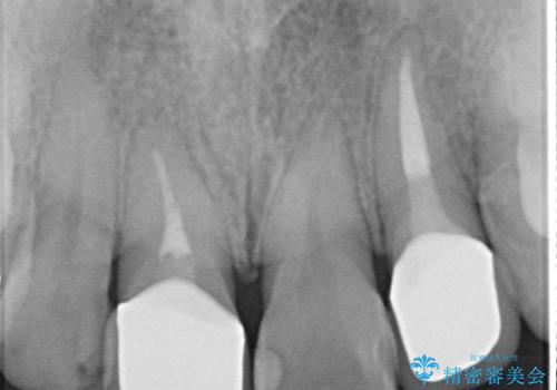 前歯治したい『根管治療　セラミック治療』の治療後
