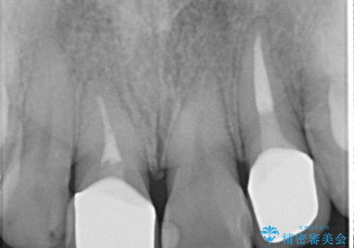 前歯治したい『根管治療 セラミック治療』の治療後