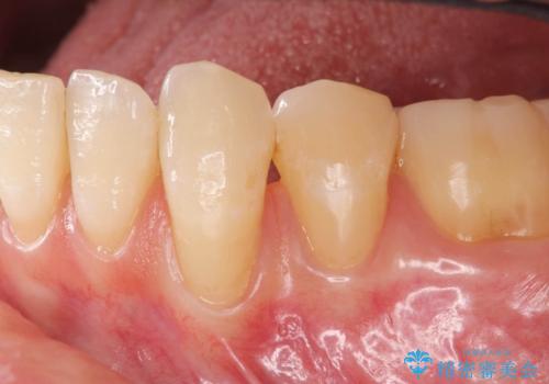 [ 歯ぐきのさがり ]   歯肉退縮に対して行う結合組織移植術の治療前