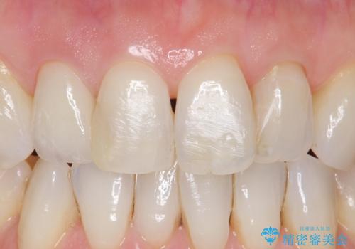前歯が取れてしまった ジルコニアクラウンでの修復の治療後