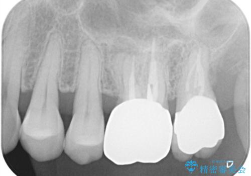 【根管治療】ズーンと痛い歯の治療。の治療後