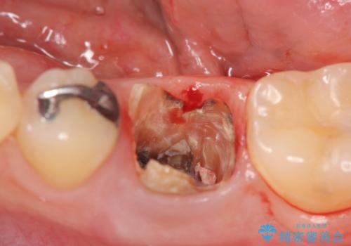 虫歯の再発による抜歯後のインプラント治療の治療前