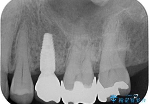 歯茎が腫れる　インプラントでの治療の治療後