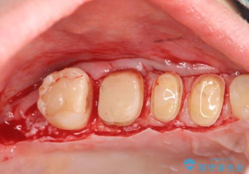 歯周外科を行い歯ぐきの整備を行うセラミック治療の治療中