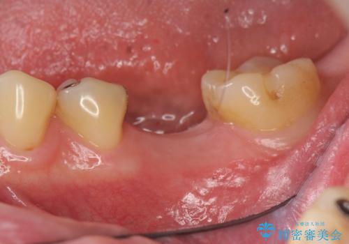 虫歯の再発による抜歯後のインプラント治療の治療中