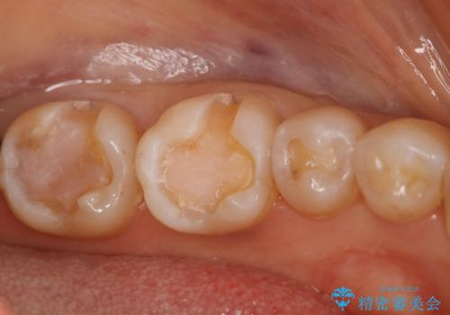 下の奥歯の銀歯を白くしたいの治療中