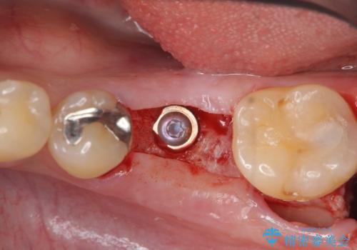 虫歯の再発による抜歯後のインプラント治療の治療中