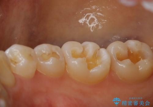 奥歯を綺麗にしたいの治療中