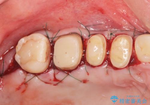 歯周外科を行い歯ぐきの整備を行うセラミック治療の治療中