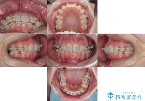 【ワイヤー矯正!】歯のでこぼこと捻じれを治したい!の治療中