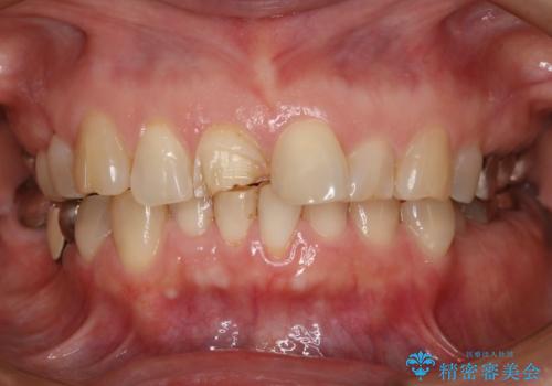 前歯が欠けたので治してほしいの症例 治療前