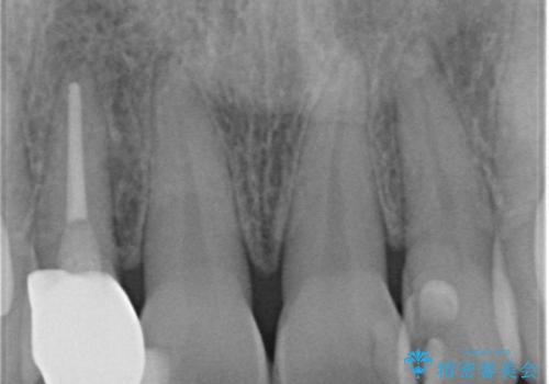 前歯が取れてしまった　ジルコニアクラウンでの修復の治療後