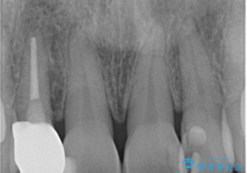 前歯が取れてしまった ジルコニアクラウンでの修復の治療後