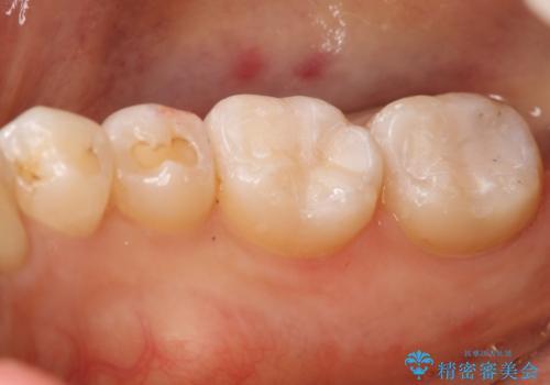 奥歯を綺麗にしたいの治療後