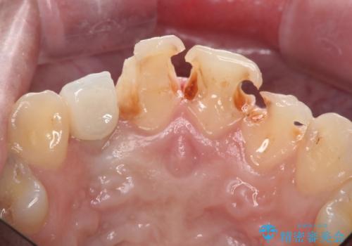 [ 審美歯科治療 ]  充填物でつぎはぎだらけの前歯をセラミックにの治療中