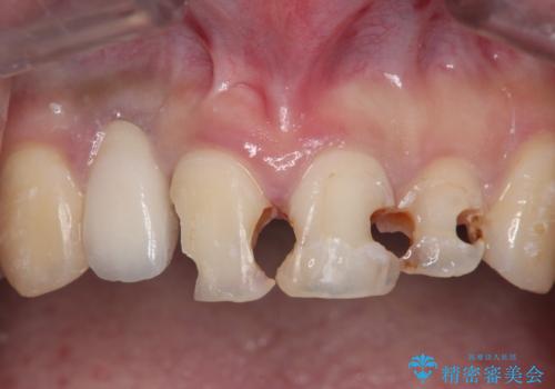[ 審美歯科治療 ]  充填物でつぎはぎだらけの前歯をセラミックにの治療中