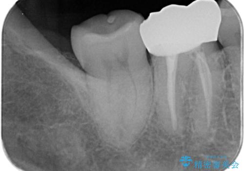 ズキズキ痛い歯 オールセラミッククラウンによる修復の治療前