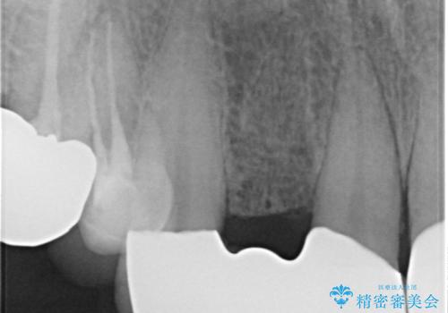 前歯が気になる。ブリッジによる治療。の治療後