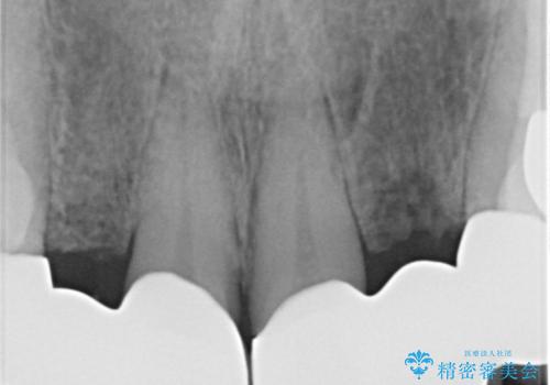 前歯が気になる。ブリッジによる治療。の治療後