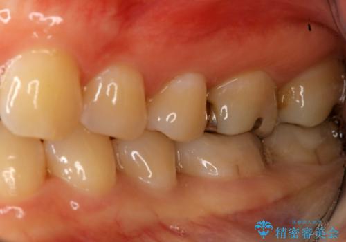 下の奥歯の銀歯を白くしたいの治療後
