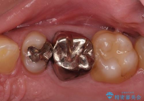銀歯を白くしたい・・の症例 治療前