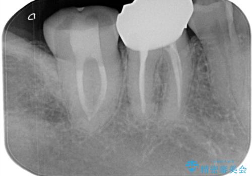 ズキズキ痛い歯 オールセラミッククラウンによる修復の治療中