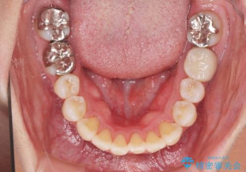 捻れた奥歯 突き出た前歯を治したいの治療後