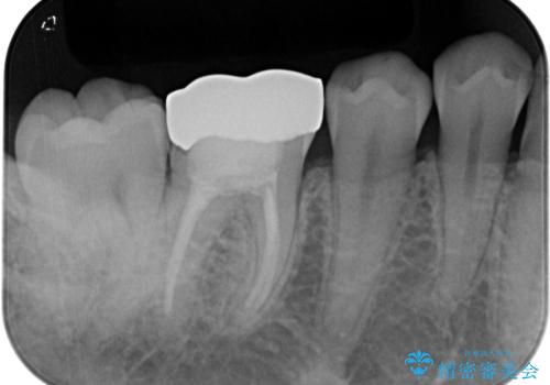 銀歯を白くしたい オールセラミッククラウンの治療前
